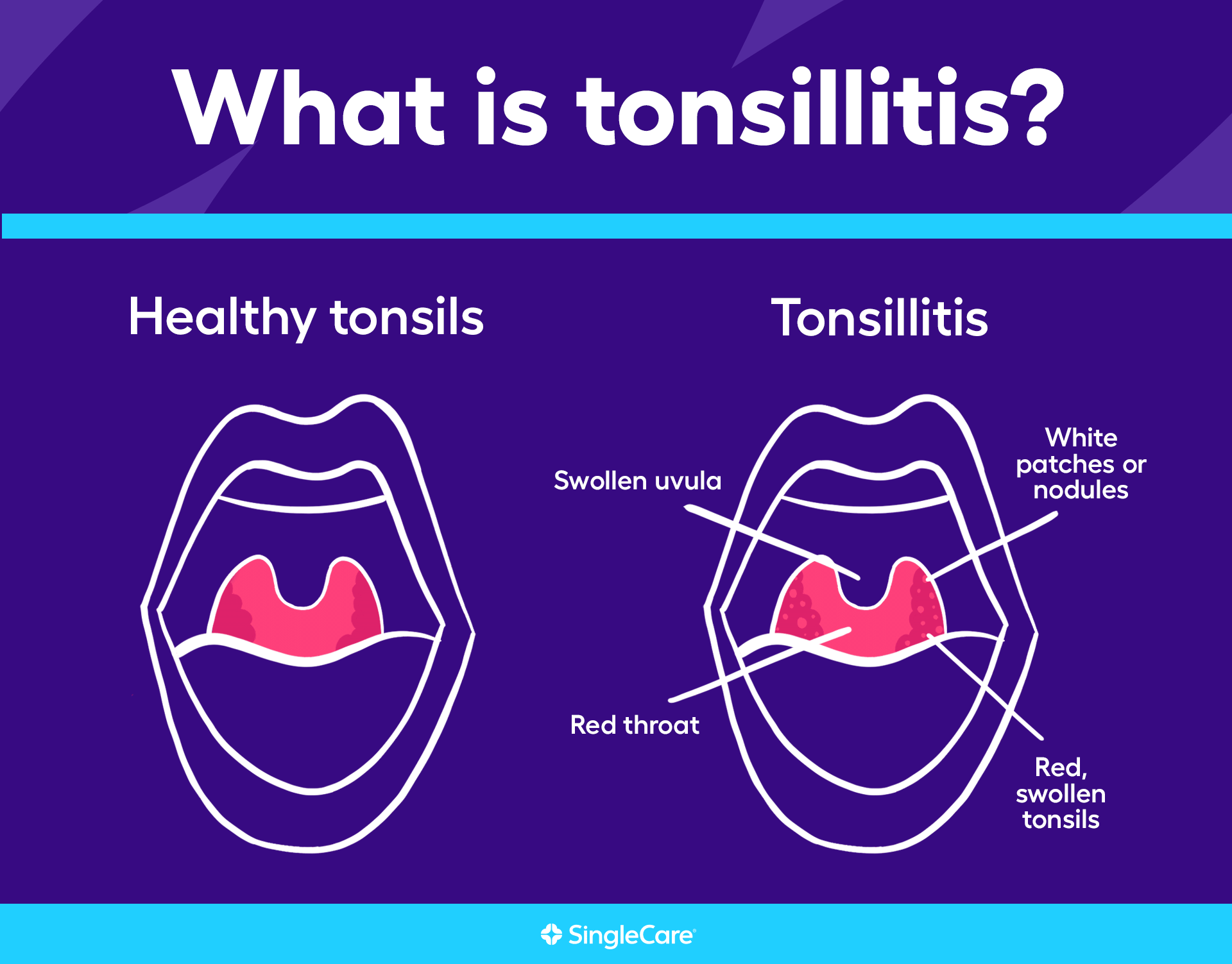 Image of healthy tonsils and tonsils with tonsilitis