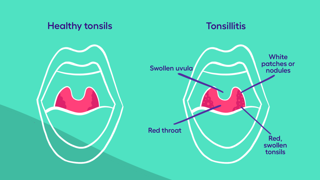 tonsillitis chronic