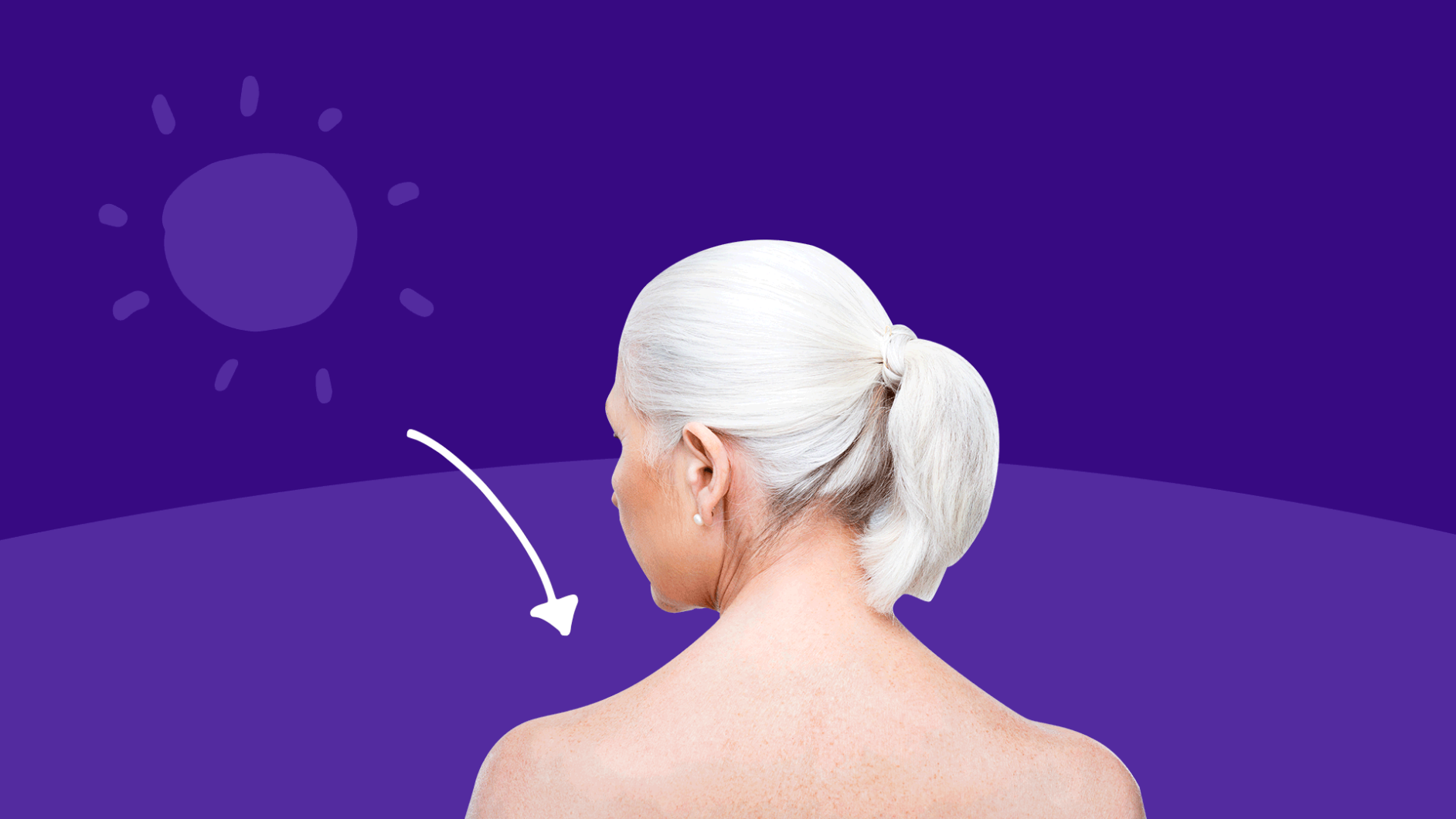 Photosensitivity: What is a sun allergy? Causes, symptoms, treatments